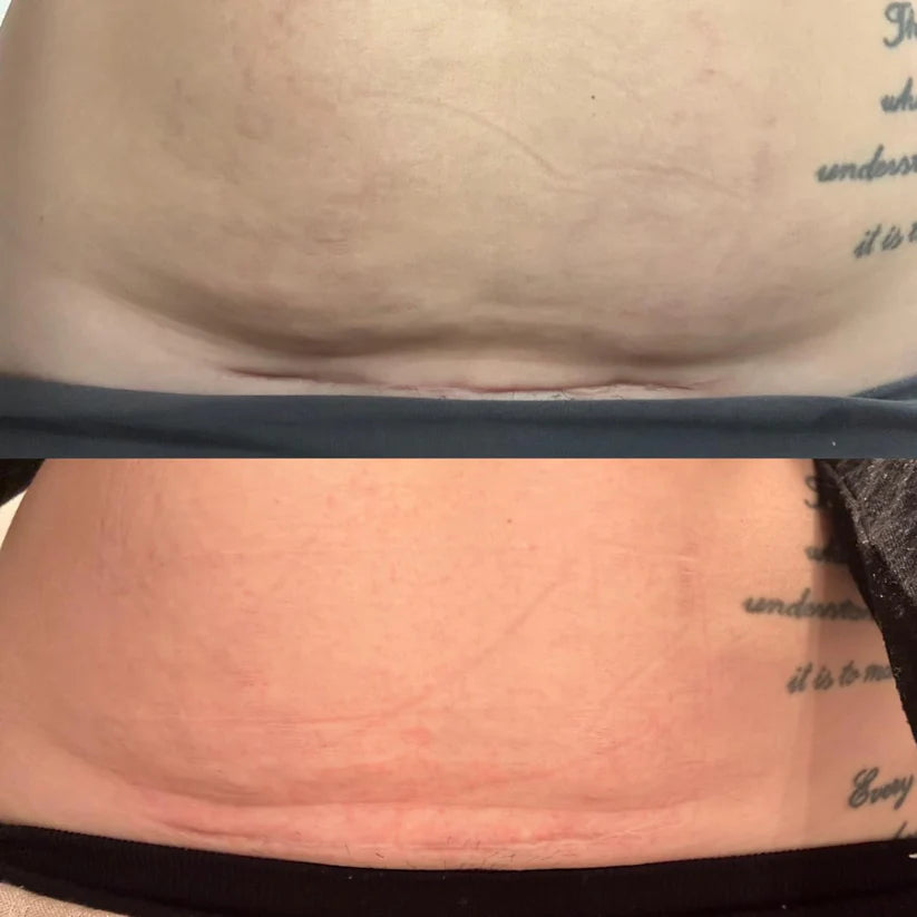 Berosely Pure Scar Tape