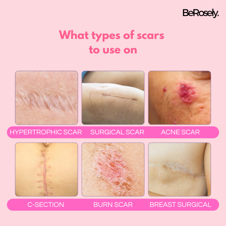 Berosely Pure Scar Tape
