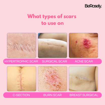 Berosely Pure Scar Tape