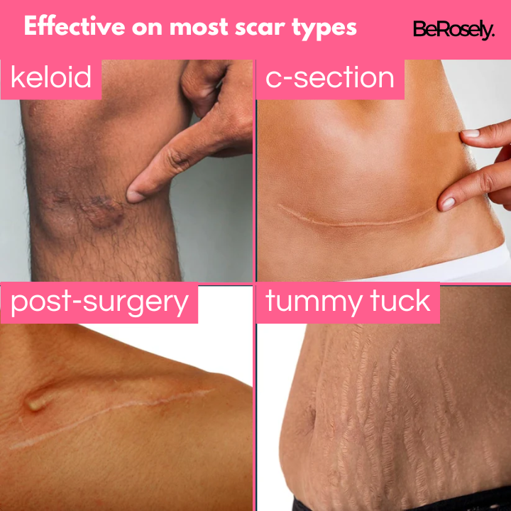 Berosely Pure Scar Tape