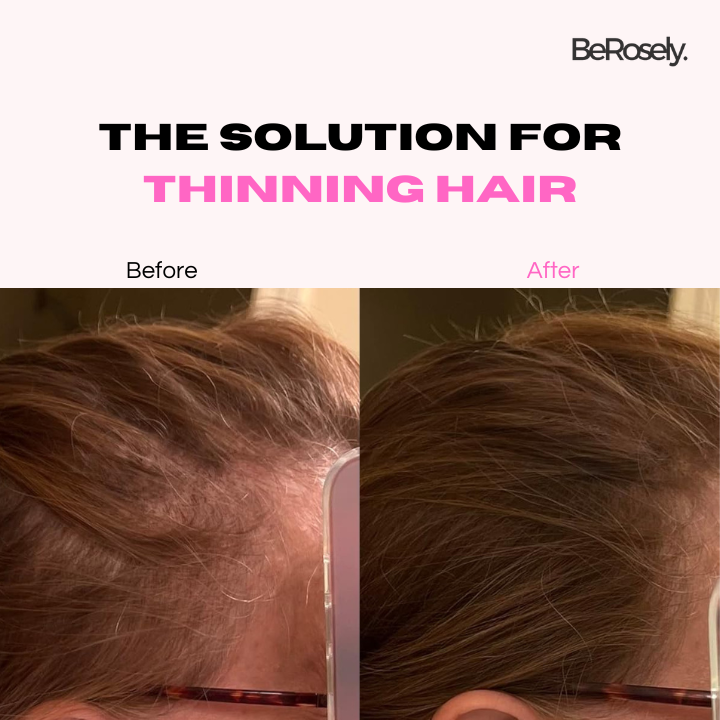 HairCover™ - Preventing a thin hairline